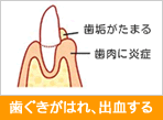 歯ぐきのはれ、出血する