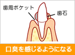 口臭を感じるようになる